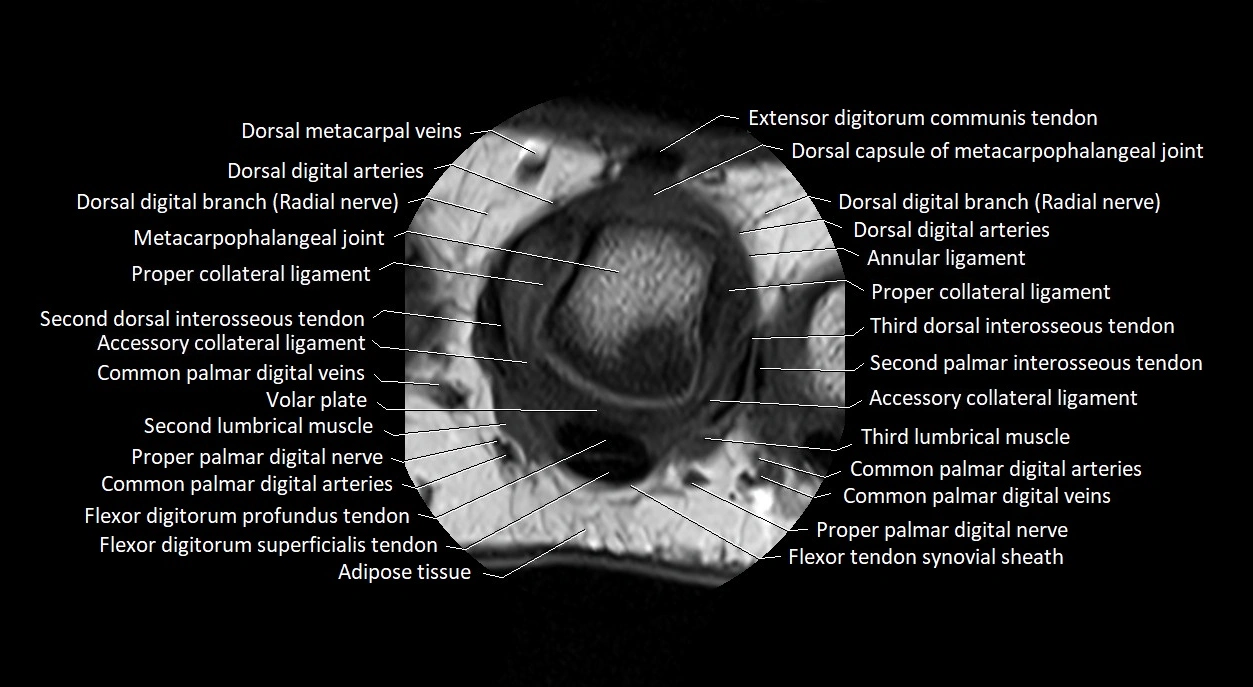 Finger anatomy axial cross sectional 3T image image 23.webp